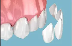 Cosmetic dentistry and veneers service card — Root Care Dental Clinic, Gurugram