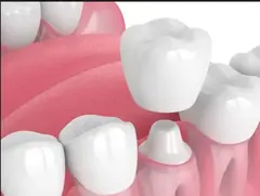 Dental crowns and veneers service card — Root Care Dental Clinic, Sector 49 Gurugram