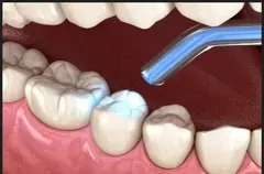 Dental fillings service card — Root Care Dental Clinic, Gurugram