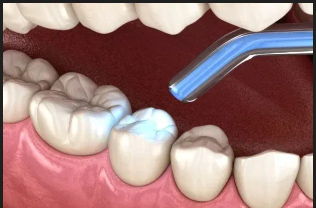 Dental fillings service card — Root Care Dental Clinic, Gurugram