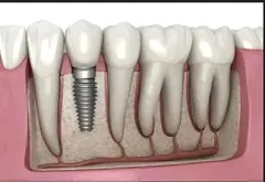 Dental implants service card — Root Care Dental Clinic, Sector 49 Gurugram