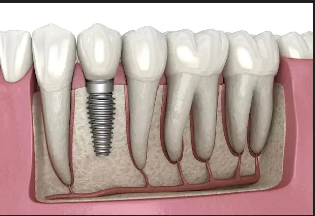 Dental implants service card — Root Care Dental Clinic, Sector 49 Gurugram