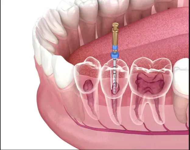 Root canal treatment service card — Root Care Dental Clinic, Gurugram