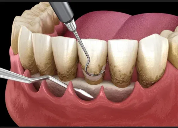 Scaling and root planing service card — Root Care Dental Clinic, Sector 49 Gurugram