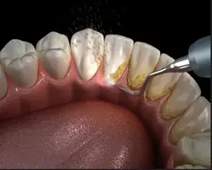 Professional teeth cleaning service card — Root Care Dental Clinic, Sector 49 Gurugram