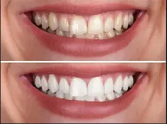 Professional teeth whitening service card — Root Care Dental Clinic, Gurugram