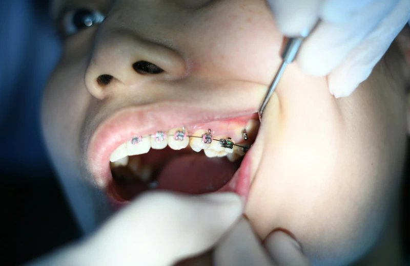 Braces and Invisalign treatment at Root Care Dental Clinic, Gurugram