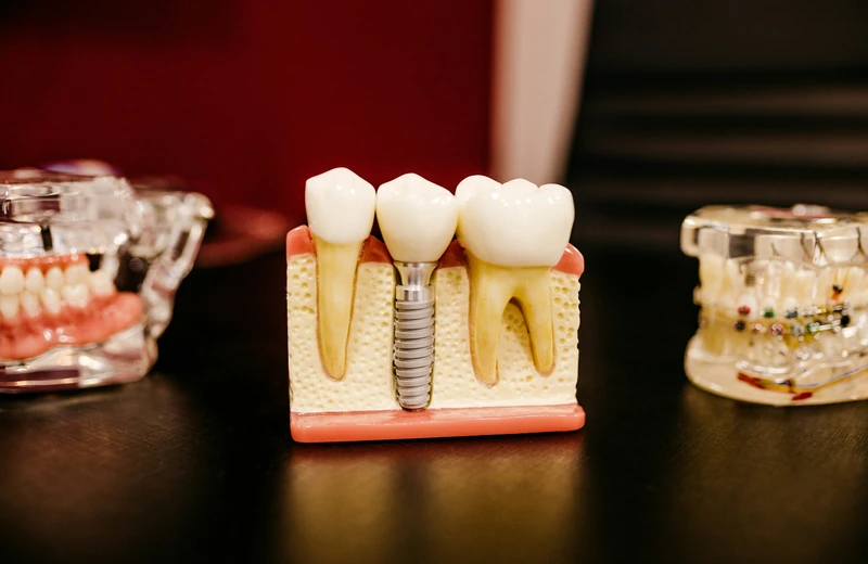 Dental implants at Root Care Dental Clinic, Sector 49 Gurugram