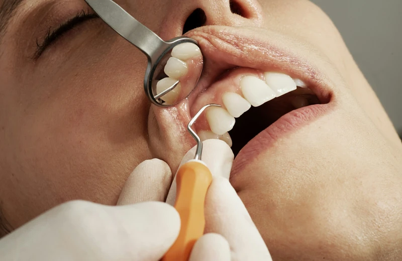 Veneers and crowns at Root Care Dental Clinic, Sector 49 Gurugram
